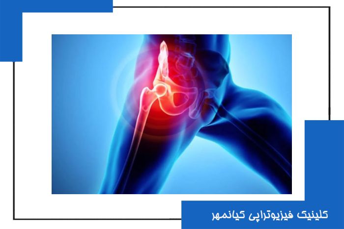 فیزیوتراپی لگن